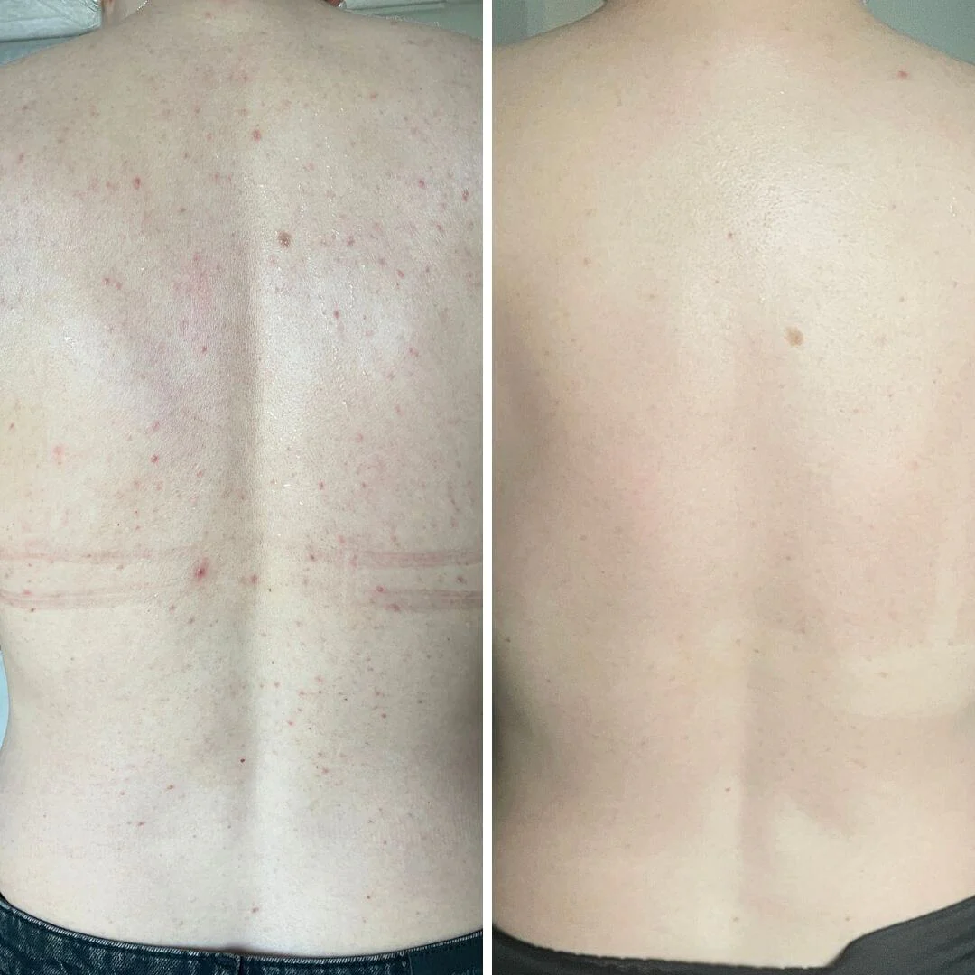 Salicylzuur spray tegen puistjes en verstopte poriën — Salicylzuur spray tegen puistjes en onzuiverheden. Met salicylzuur en glycolzuur voor diepe reiniging en gladde huid. - Image 6